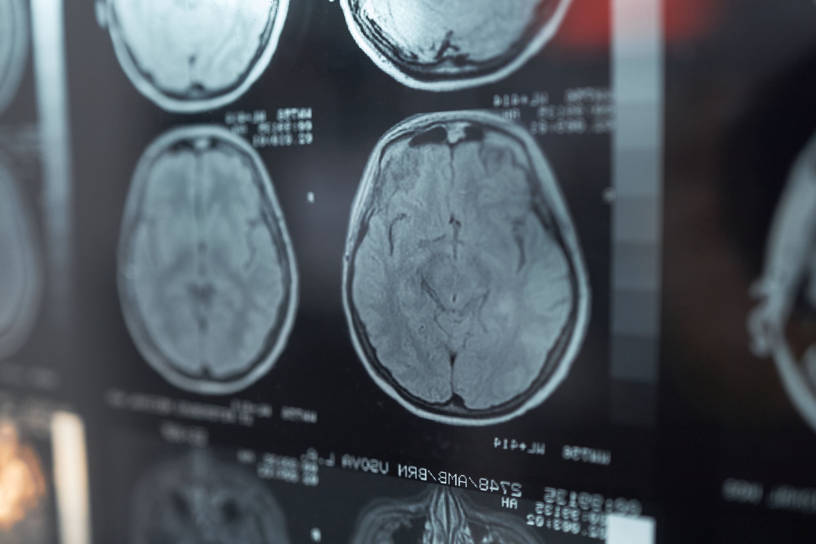 MRI brain scan used to diagnose traumatic brain injury